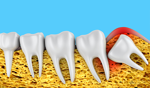 親知らずの抜歯